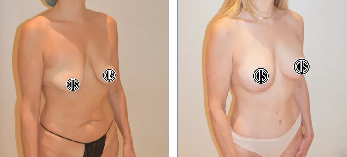 Before and after: breast lift, breast augmentation, and abdominoplasty.