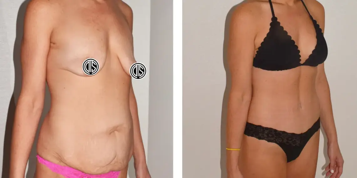 Before and after: breast lift, breast augmentation, and abdominoplasty.